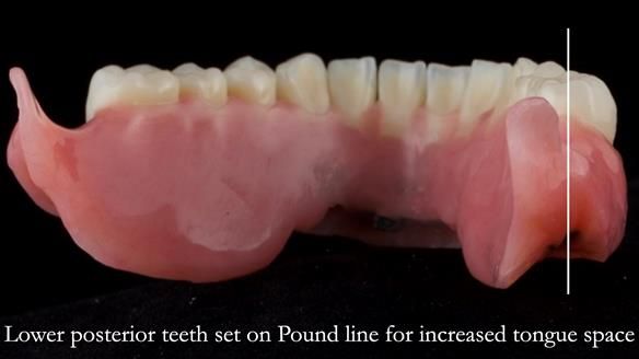 Managing poor implant positioning with complete dentures and Locator attachments - full protocol Newsletter 41