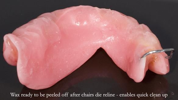 Newsletter 82 Mary - A complete upper and a one-tooth gasket denture
