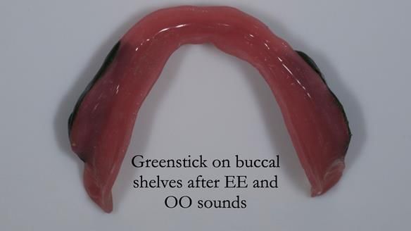 Complete denture Class II div 2 deep overbite Newsletter 39