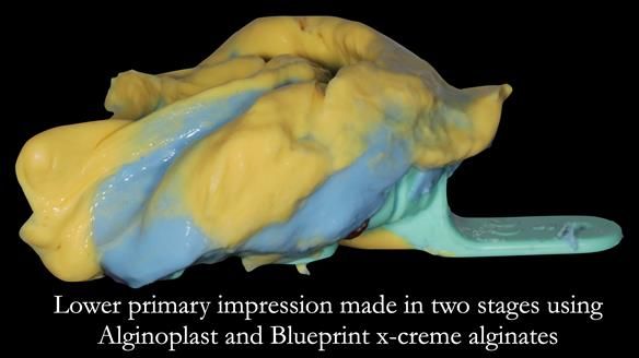 Newsletter 55 Provision of metal based partial dentures for Zephyrine with a repaired cleft lip and palate