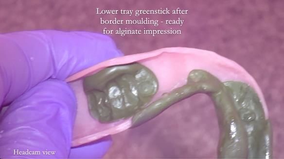 Newsletter 82 Mary - A complete upper and a one-tooth gasket denture