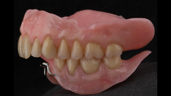 Figure 36 Mk 1 immediate acrylic based dentures. Schottlander Enigmalife teeth. 0.9 mm wrought stainless steel clasps on LR4 and LL3