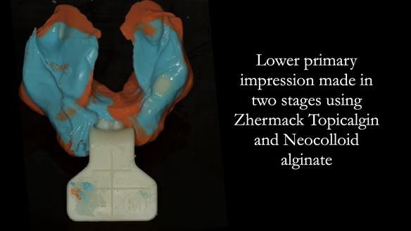 Complete denture Class II div 2 deep overbite Newsletter 39