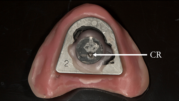 Figure 83 A plastic countersink hole is placed and fitted over the apex.