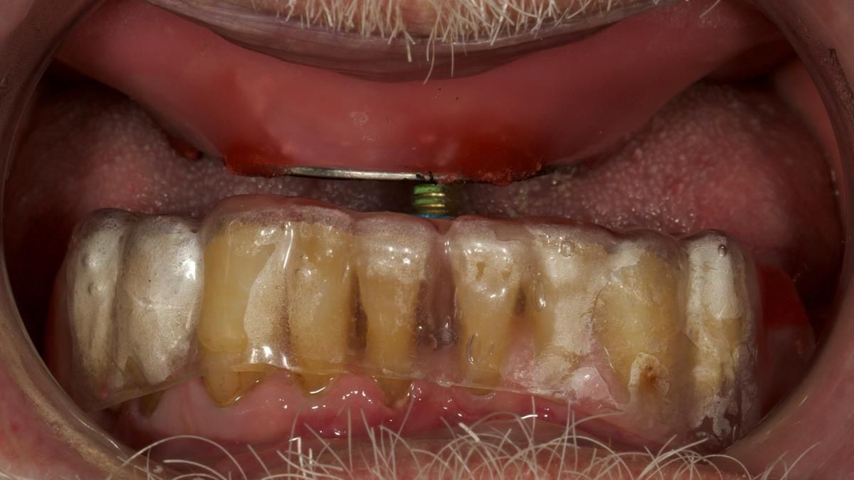 Newsletter 87 – Father Peter: A Partial Denture that needed Minor Miracle