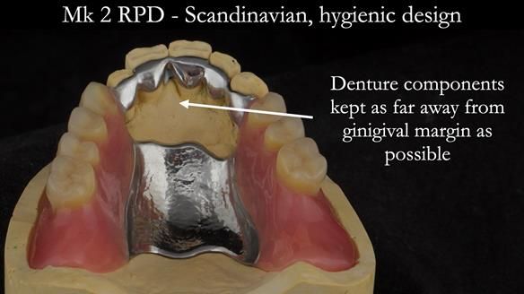 Finlay's Case Study Newsletter 40 - Immediate Mk 1 RPD to Definitive Mk 2 RPD - full protocol