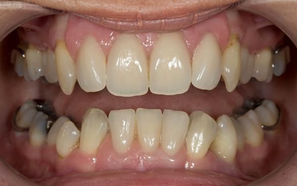 Figure 79 Definitive dentures fitted 9 months after extractions. Schottlander Enigmalife teeth