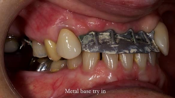 Newsletter 81 - Pam’s Story — how a partial denture changed her life (+ live walkthrough this Thursday)