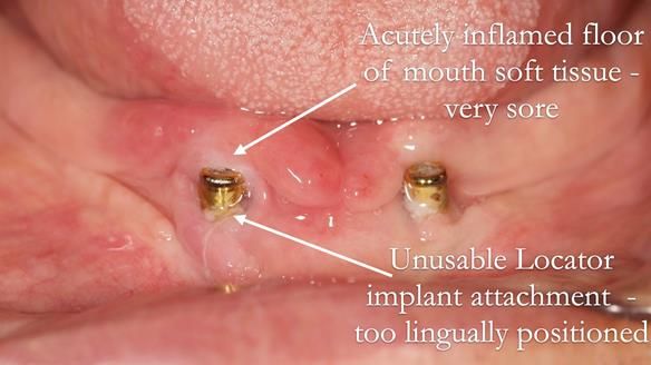 Managing poor implant positioning with complete dentures and Locator attachments - full protocol Newsletter 41