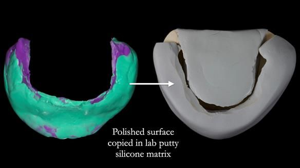 Newsletter 83: Sheila’s Complete Denture Success