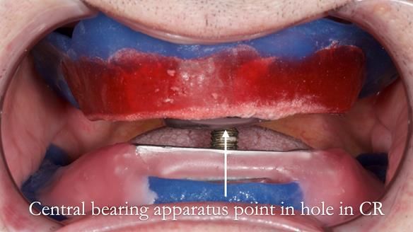 Newsletter 80 - Gordon’s dentures: the one case in 1,000 where my technique failed