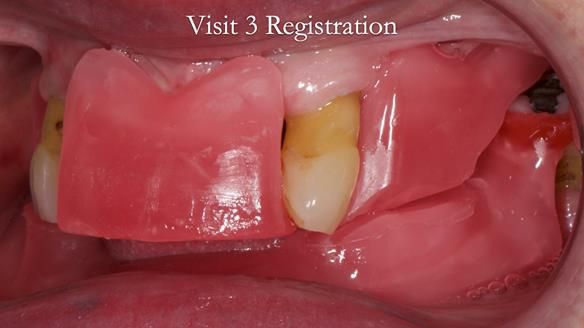 Finlay's Newsletter 59 Ultra hard partial dentures made for Gill