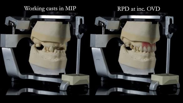 Newsletter 81 - Pam’s Story — how a partial denture changed her life (+ live walkthrough this Thursday)