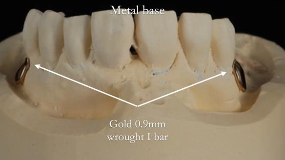 Newsletter 56 showing the making and fitting of a bilateral free end saddle upper removable partial denture (RPD) for patient with pemphigus