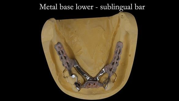 Finlay's Case Study Newsletter 40 - Immediate Mk 1 RPD to Definitive Mk 2 RPD - full protocol