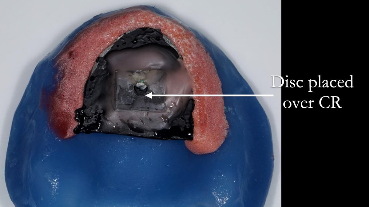 Fin’s Newsletter 88 — Complete dentures - full protocol… he rearranged his own teeth!