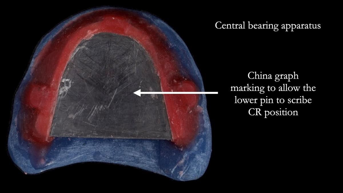 Fin’s Newsletter 88 — Complete dentures - full protocol… he rearranged his own teeth!