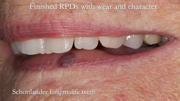 Eileen's transformation with upper and lower RPDs of Scandinavian hygienic design FULL PROTOCOL
