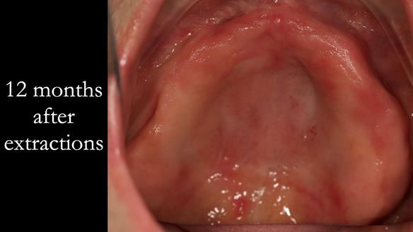 Newsletter 52 Managing Jo’s failing dentition with extractions and Mk 1/Mk 2 complete upper dentures and lower partial dentures FULL PROTOCOL
