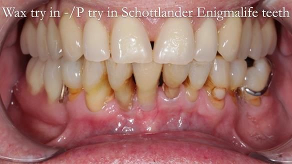 Newsletter 54 case presentation upper complete denture and lower Scandinavian designed hygienic partial denture for David