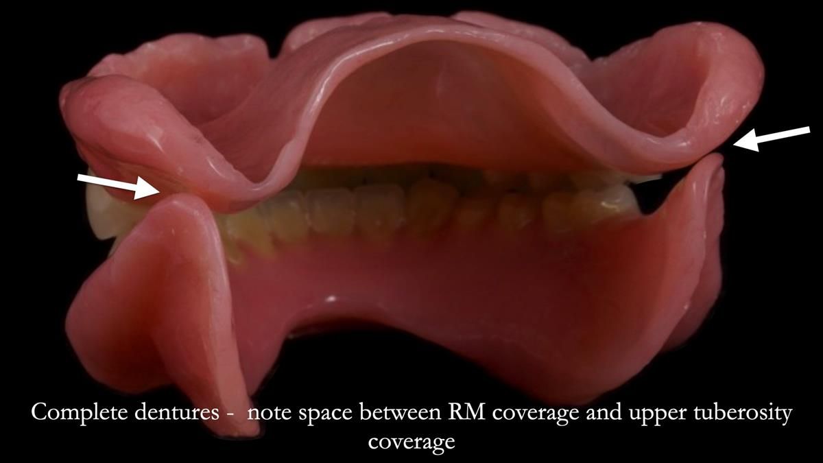 Fin’s Newsletter 88 — Complete dentures - full protocol… he rearranged his own teeth!