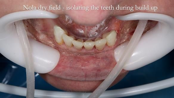 Newsletter 52 Managing Jo’s failing dentition with extractions and Mk 1/Mk 2 complete upper dentures and lower partial dentures FULL PROTOCOL