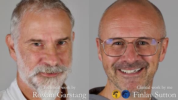 Newsletter 51 Managing Anne’s failing dentition with distal extension base RPD/Splint FULL PROTOCOL