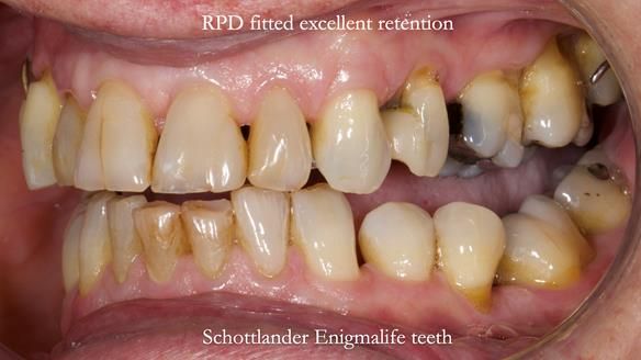 Finlay's Newsletter 64 case study - provision of a Kennedy class 2 metal based Scandinavian RPD for Ian