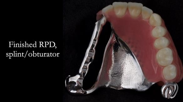 Upper metal base partial denture/occlusal stabilisation splint/obturator - full protocol