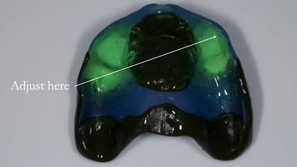 Newsletter 57 showcases the making and fitting process of implant-supported complete dentures for Alisdair