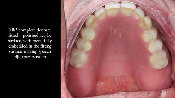 Newsletter 77: Jeremy’s case – immediate complete upper denture