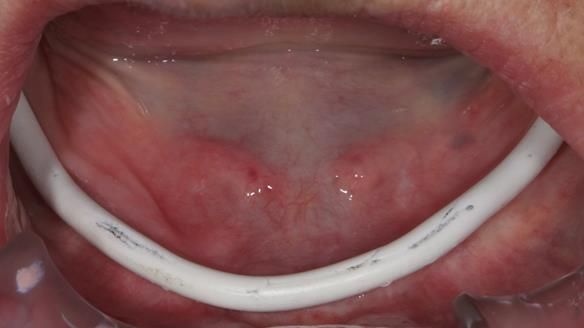 Newsletter 83: Sheila’s Complete Denture Success