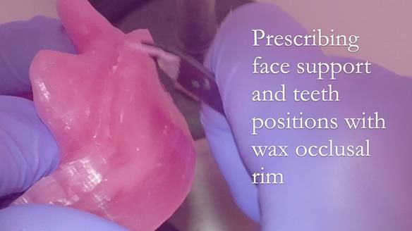 Upper metal base partial denture/occlusal stabilisation splint/obturator - full protocol