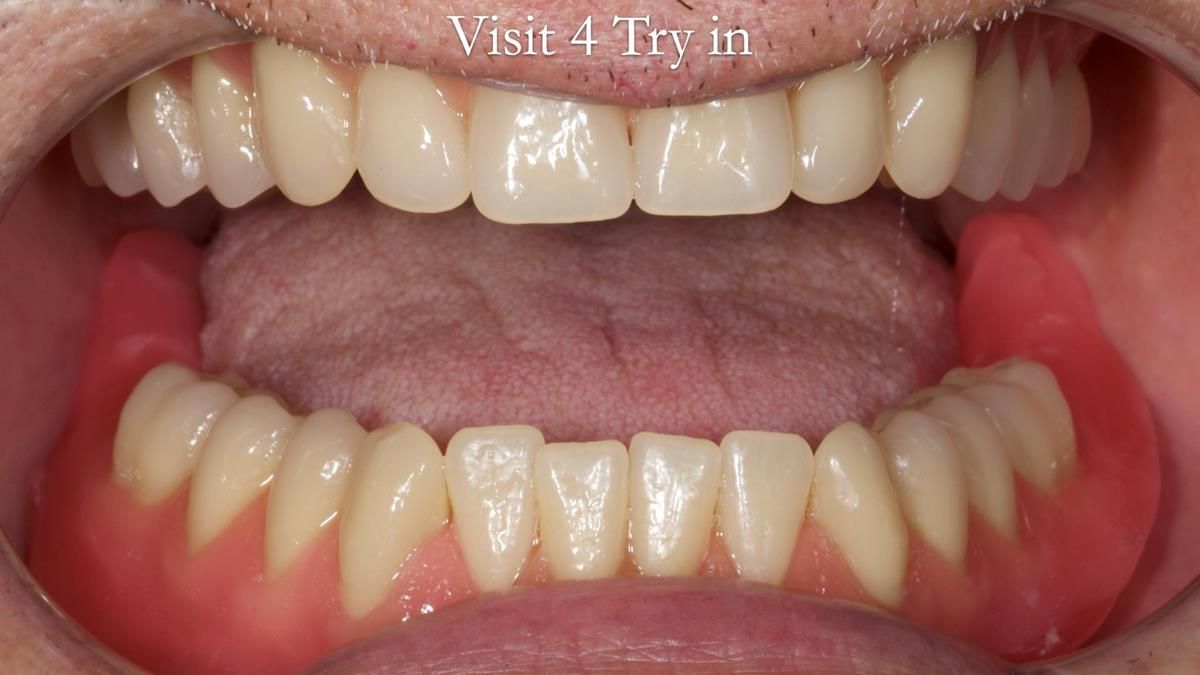 Fin’s Newsletter 88 — Complete dentures - full protocol… he rearranged his own teeth!