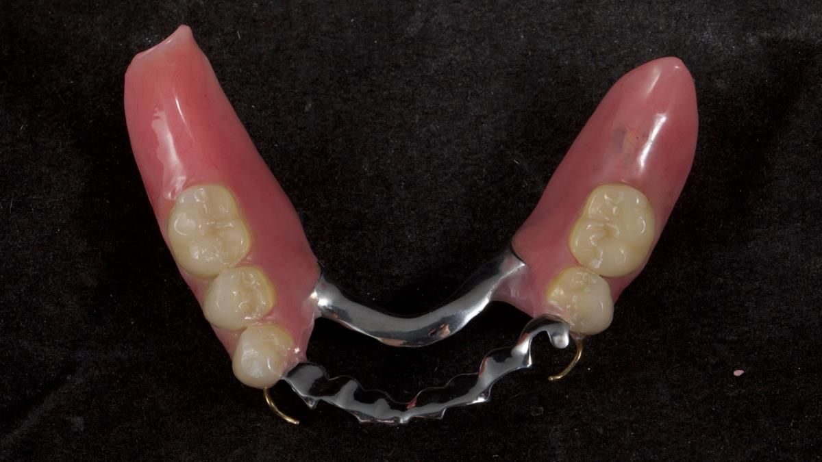 Newsletter 87 – Father Peter: A Partial Denture that needed Minor Miracle