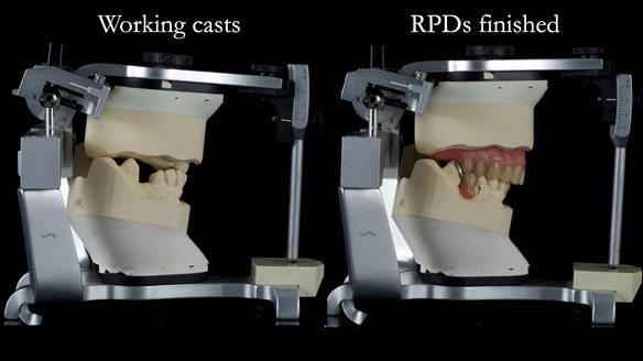 Newsletter 55 Provision of metal based partial dentures for Zephyrine with a repaired cleft lip and palate