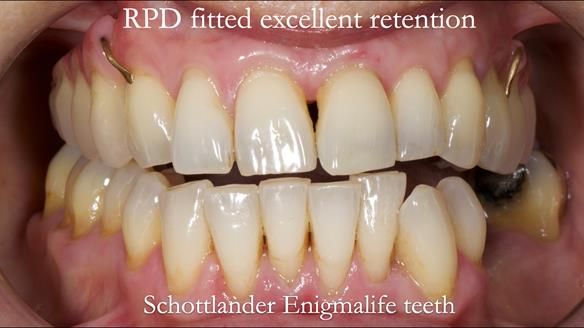 Newsletter 56 showing the making and fitting of a bilateral free end saddle upper removable partial denture (RPD) for patient with pemphigus