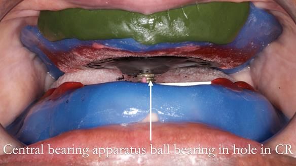 Newsletter 53 showing the making and fitting of ultra life-like dentures for Valena