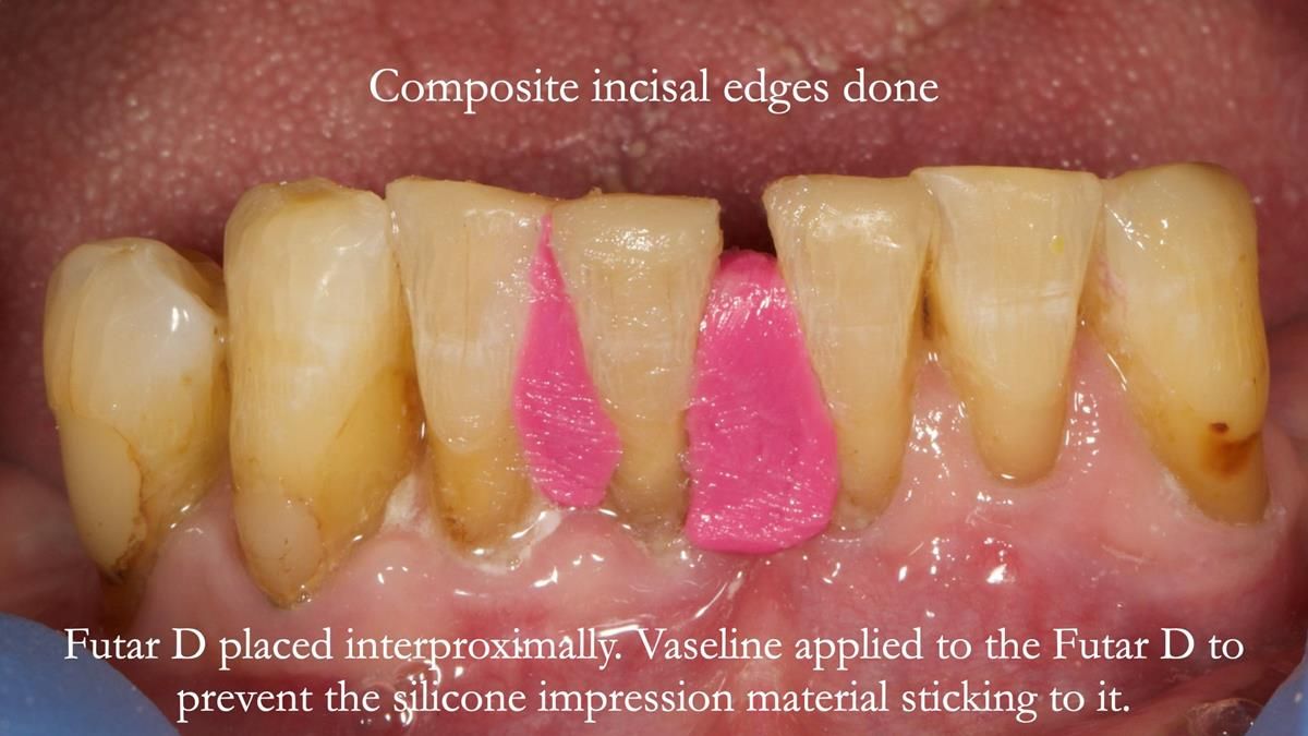 Newsletter 87 – Father Peter: A Partial Denture that needed Minor Miracle