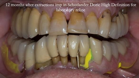 Ken – going downhill, first class