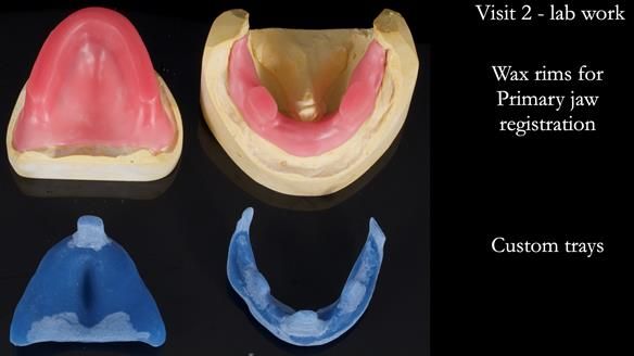 Newsletter 80 - Gordon’s dentures: the one case in 1,000 where my technique failed
