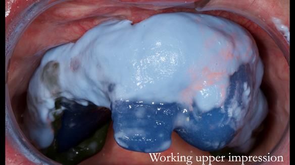 Newsletter 55 Provision of metal based partial dentures for Zephyrine with a repaired cleft lip and palate