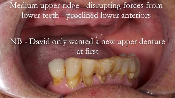 Newsletter 54 case presentation upper complete denture and lower Scandinavian designed hygienic partial denture for David