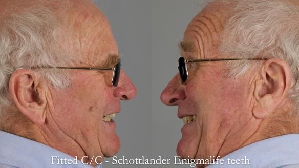 Complete denture Class II div 2 deep overbite Newsletter 39