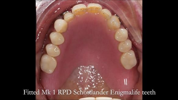 Finlay's Case Study Newsletter 40 - Immediate Mk 1 RPD to Definitive Mk 2 RPD - full protocol