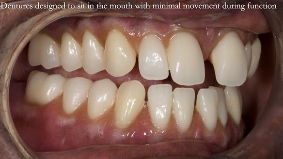 Newsletter 53 showing the making and fitting of ultra life-like dentures for Valena