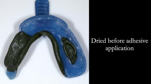 Finlay's Newsletter 61 provision of a lower unilateral free end saddle metal based partial denture for Joyce