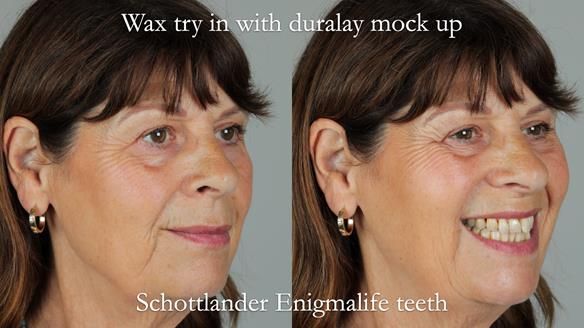 Newsletter 56 showing the making and fitting of a bilateral free end saddle upper removable partial denture (RPD) for patient with pemphigus