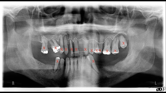 Figure 5 Pre-treatment radiograph indicating bone levels and showing teeth to be removed