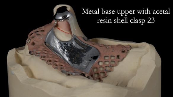 Newsletter 55 Provision of metal based partial dentures for Zephyrine with a repaired cleft lip and palate